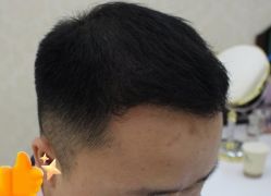 -大麦微针植发丨全国连锁