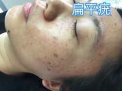 -美丽人生祛斑扁平疣汗管瘤中心