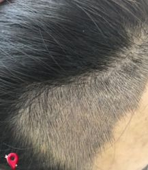 -大麦微针植发丨全国连锁