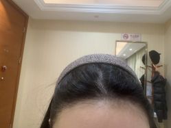 -碧莲盛·不剃发植发