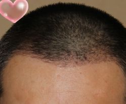 -大麦微针植发丨全国连锁