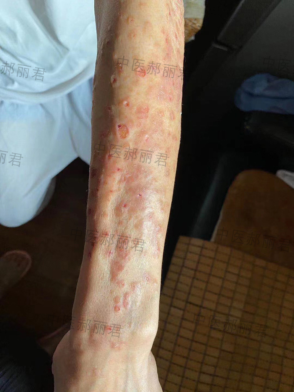 鹅肉引发的湿疮