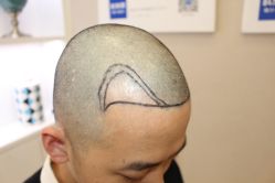 -大麦微针植发丨全国连锁