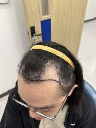 体验前-大麦微针植发全国连锁