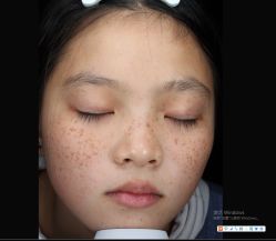体验前-丽美妍医疗美容·皮秒·立体分层抗衰