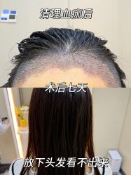 -大麦微针植发全国连锁