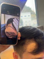 -碧莲盛·不剃发植发