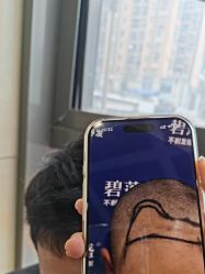 -碧莲盛·不剃发植发