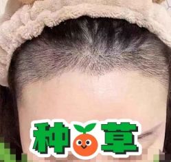 -大麦微针植发丨全国连锁