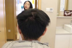 -大麦微针植发丨全国连锁
