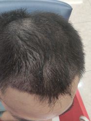 -大麦微针植发全国连锁