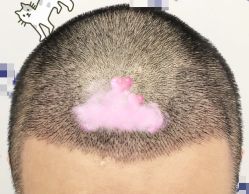 -大麦微针植发全国连锁