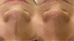 -海涛医疗美容·面部抗衰·注射美鼻