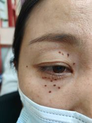 -北京美痣堂古方祛痣斑疣瘊