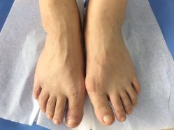 -德哥灰指甲脚气甲沟炎跖疣护理