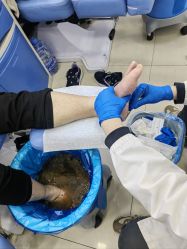 -德哥灰指甲脚气甲沟炎跖疣护理