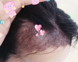 -大麦微针植发全国连锁