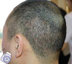 -大麦微针植发丨全国连锁