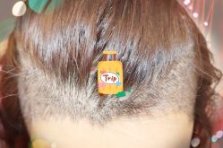 -大麦微针植发全国连锁