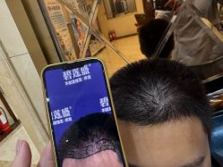 -碧莲盛·不剃发植发