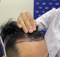 -碧莲盛·不剃发植发