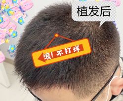 -大麦微针植发全国连锁