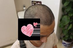 -大麦微针植发丨全国连锁