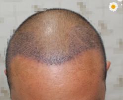 -大麦微针植发丨全国连锁