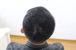 -大麦微针植发丨全国连锁