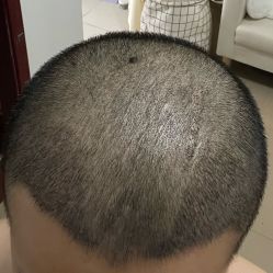 -大麦微针植发全国连锁