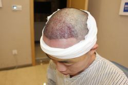 -大麦微针植发丨全国连锁