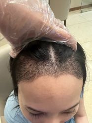 -大麦微针植发全国连锁