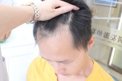 点击看大图 -大麦微针植发丨全国连锁