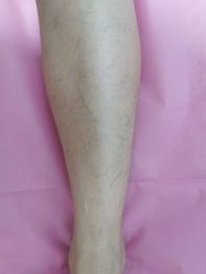 -薇兰专业脱毛连锁机构