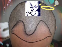 -大麦微针植发全国连锁