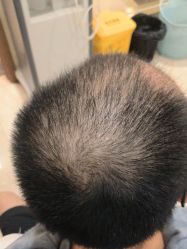 -碧莲盛·不剃发植发