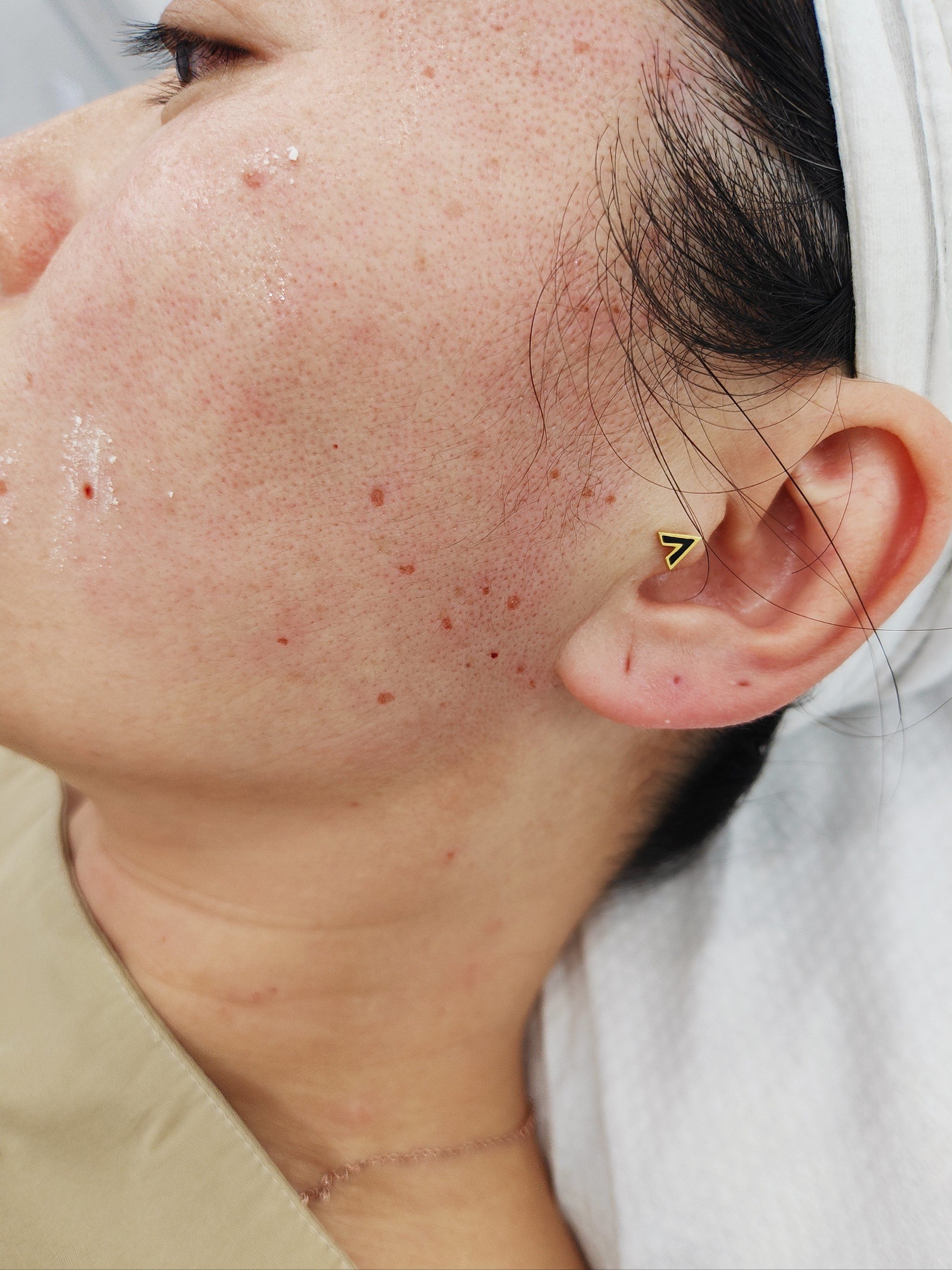 瑶芳清颜扁平疣祛除中