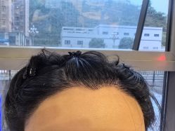 -碧莲盛·不剃发植发