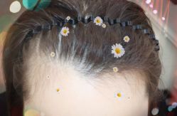 -大麦微针植发全国连锁