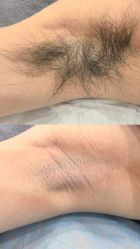 -薇兰专业脱毛连锁机构