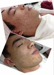 -苗方清颜专业祛痘