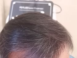 -碧莲盛·不剃发植发