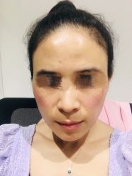 体验后-More摩尔医美の注射线雕光电中心