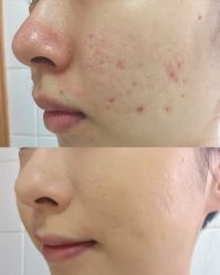 -美肤盾祛痘·问题肌头疗管理中心