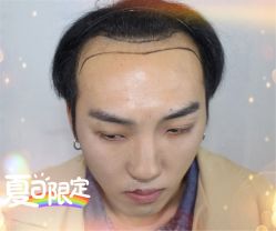 -大麦微针植发全国连锁