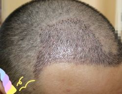 -大麦微针植发丨全国连锁