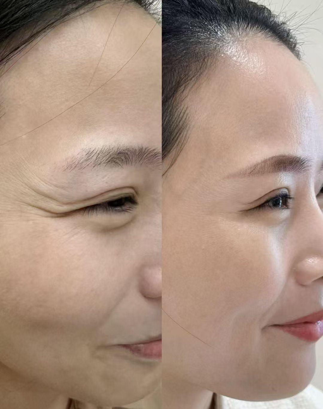 动态纹不去除,那就慢慢变成静态纹,顽固纹