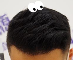 -大麦微针植发全国连锁