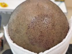 点击看大图 -碧莲盛·不剃发植发