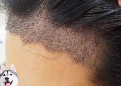 -大麦微针植发丨全国连锁